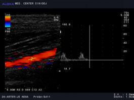 Ultrazvok žil nog - znižana hitrost v arteriji